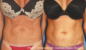fo plus 1a 8weeks 1to2weeksapart 60mj cutoff43 10to12mineachtreatment 300x174 1