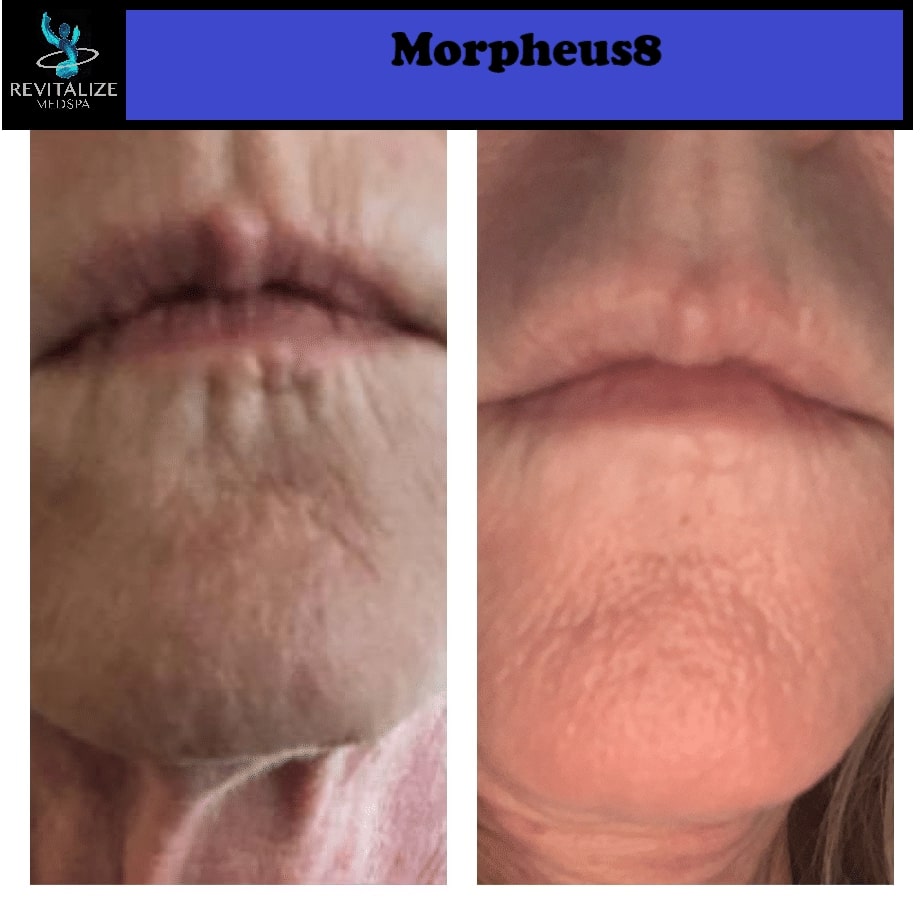 morpheus8 of lips